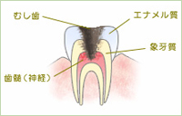 末期の虫歯の場合