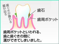 歯周病（中期）