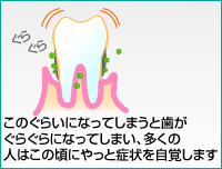 歯周病（末期）
