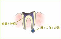 虫歯（末期）