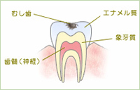 初期から少し進行した虫歯