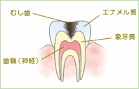 中期から末期の虫歯