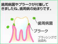 歯周病（初期）